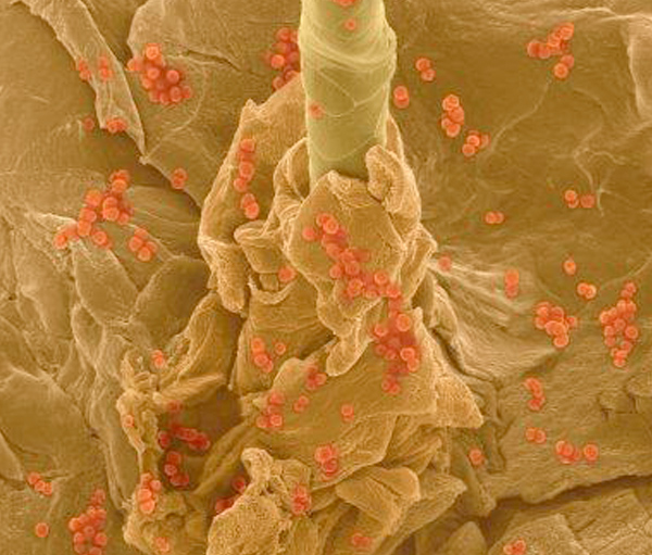 Picture of Picture of Staphylococcus aureus